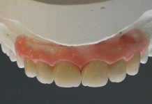 Corone in zirconia stratificata